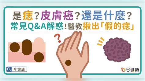 長毛痣|是痣？皮膚癌？還是什麼？常見Q&A解惑！醫教揪出「假的痣」